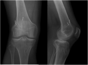 Immagine RX dopo ricostruzione con tecnica a doppio fascio 